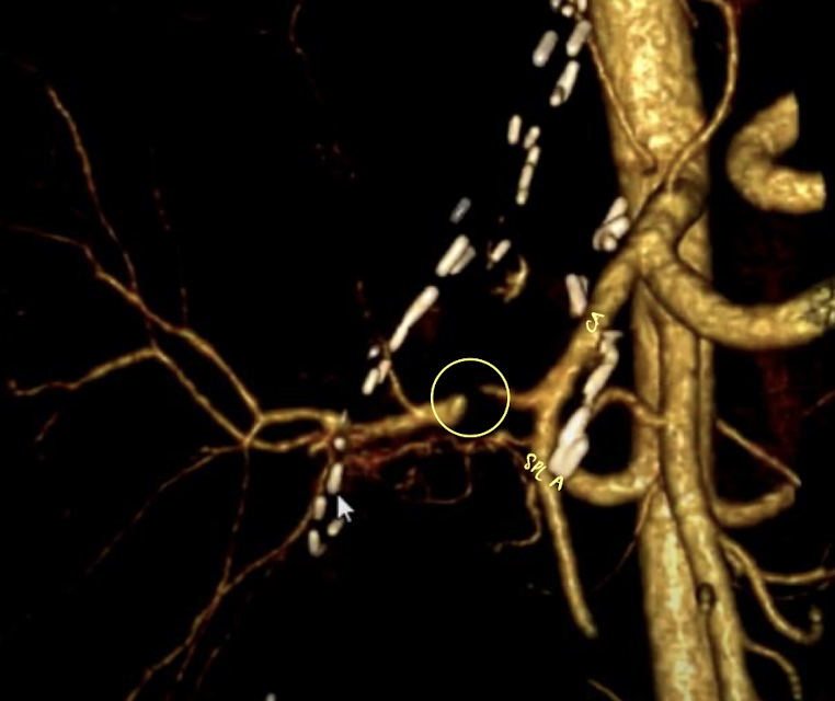 <p>what is this CT showing?</p>