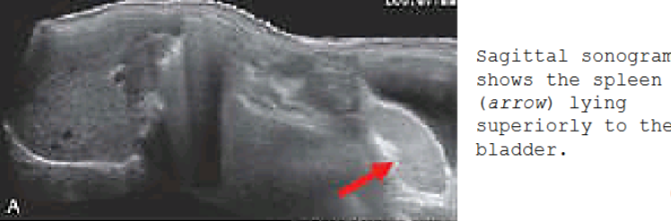 <p>AKA wandering spleen; spleen position is varaible in abdomen/pelvis due to laxity of splenic suspensory ligaments</p><p>More prone to torsion <span style="background-color: transparent;">→ acute pain and infarction of spleen</span></p>