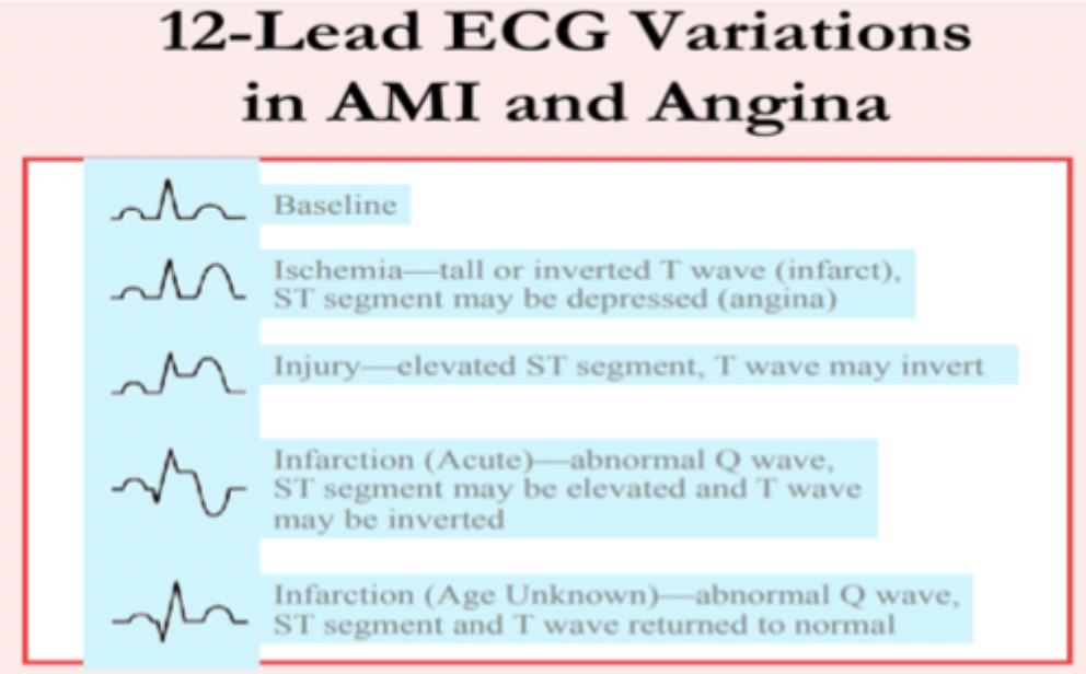 <p><strong>Abnormal Q wave</strong>; <em>ST segment</em> and <em>T wave</em> have <em>returned to normal</em></p>
