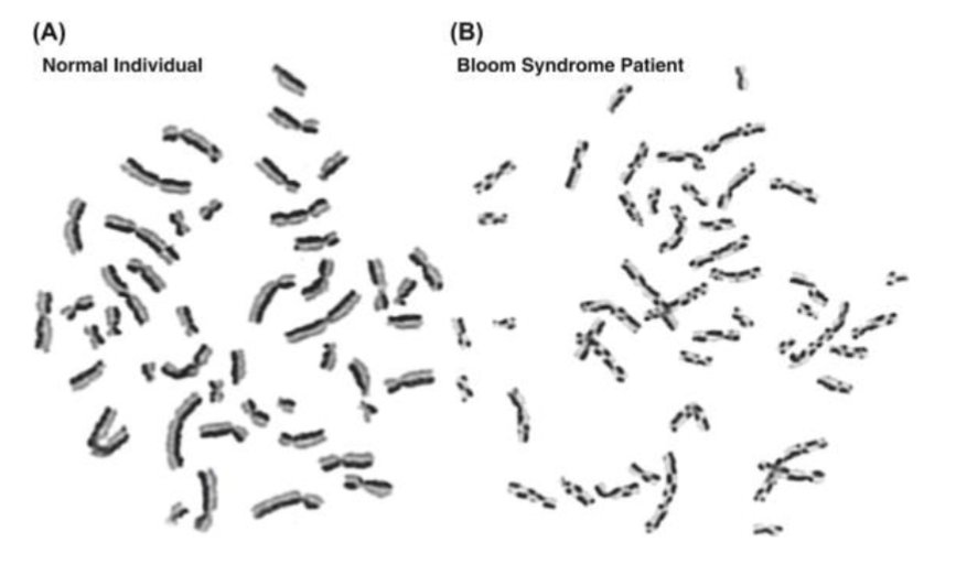 <p>Autosomal recessive condition cause by Defects in the <strong><em><u>BLM gene</u></em></strong> (RecQ <strong><em>helicase</em></strong> family)</p><ul><li><p>defects in DNA helicase leads to <strong><em><u>impaired homologous recombination repair</u></em></strong>(error prone) resulting in<em> increased sister chromatid exchange + genomic instability</em></p></li></ul><p></p><p>CLINICAL FEATURES: growth deficiency, recognizable facial features, <strong><u>photosensitivity</u></strong><em> (Malar rash of face),</em> Immunodeficiency, <em><u>predisposition to cancer esp. leukemias, lymphomas + GI</u></em> (areas of high cell renewal)</p><p></p><p><strong><em><u>Hallmark = INCREASED SISTER CHROMATIC EXCHANGE</u></em></strong></p><ul><li><p>chromosomes are stained so that sister chromatid genetic material can be distinguished</p></li><li><p>sister chromatid exchange is rare in a lymphocyte from a normal individual but occurs at a high frequency in a lymphocyte from a patient with bloom syndrome</p></li></ul><p></p>