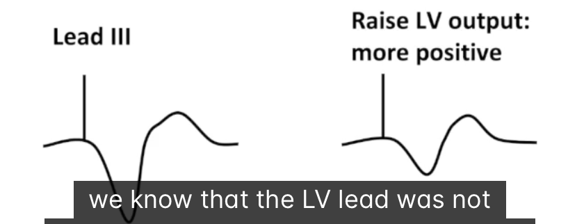 <ul><li><p>Example: BIV pacing, suspect loss of LV capture</p><ul><li><p>Raise LV output</p></li><li><p>Lead I more negative, lead I!! more positive</p></li><li><p>LV was not capturing before</p></li></ul></li></ul><p></p>