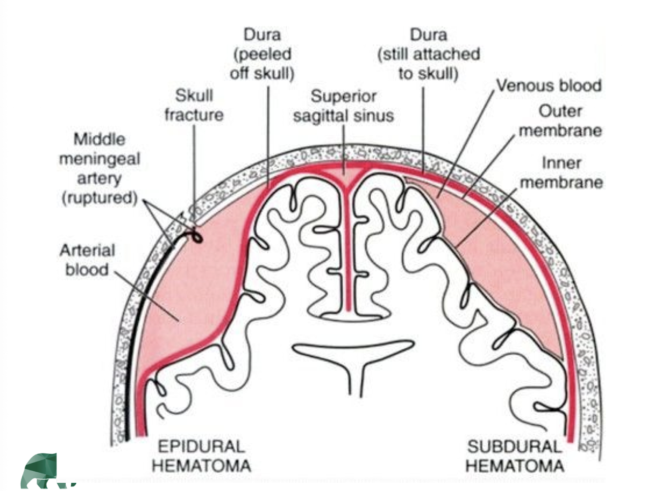 <p>what are some signs and symptoms of a cerebral contusion/hematoma?</p>