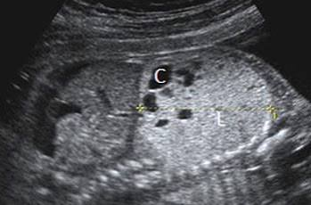 <p>abnormal formation of bronchial tree</p><ul><li><p>pulmonary tissue replaced by cysts </p></li><li><p>mediastinal shift </p></li><li><p>intact diaphragm </p></li></ul><p></p>
