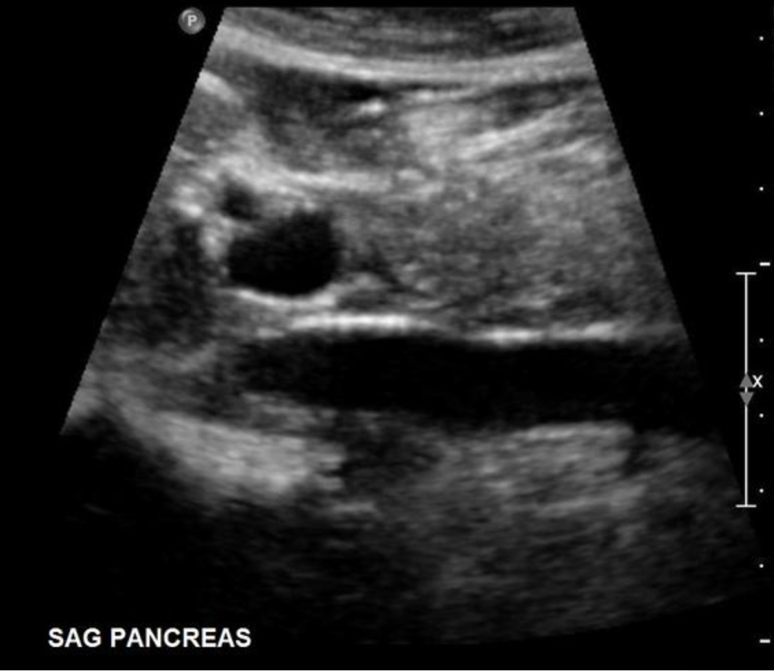 <p>Use your mouse to place your cursor over the hepatic artery and click to mark the vessel.</p>