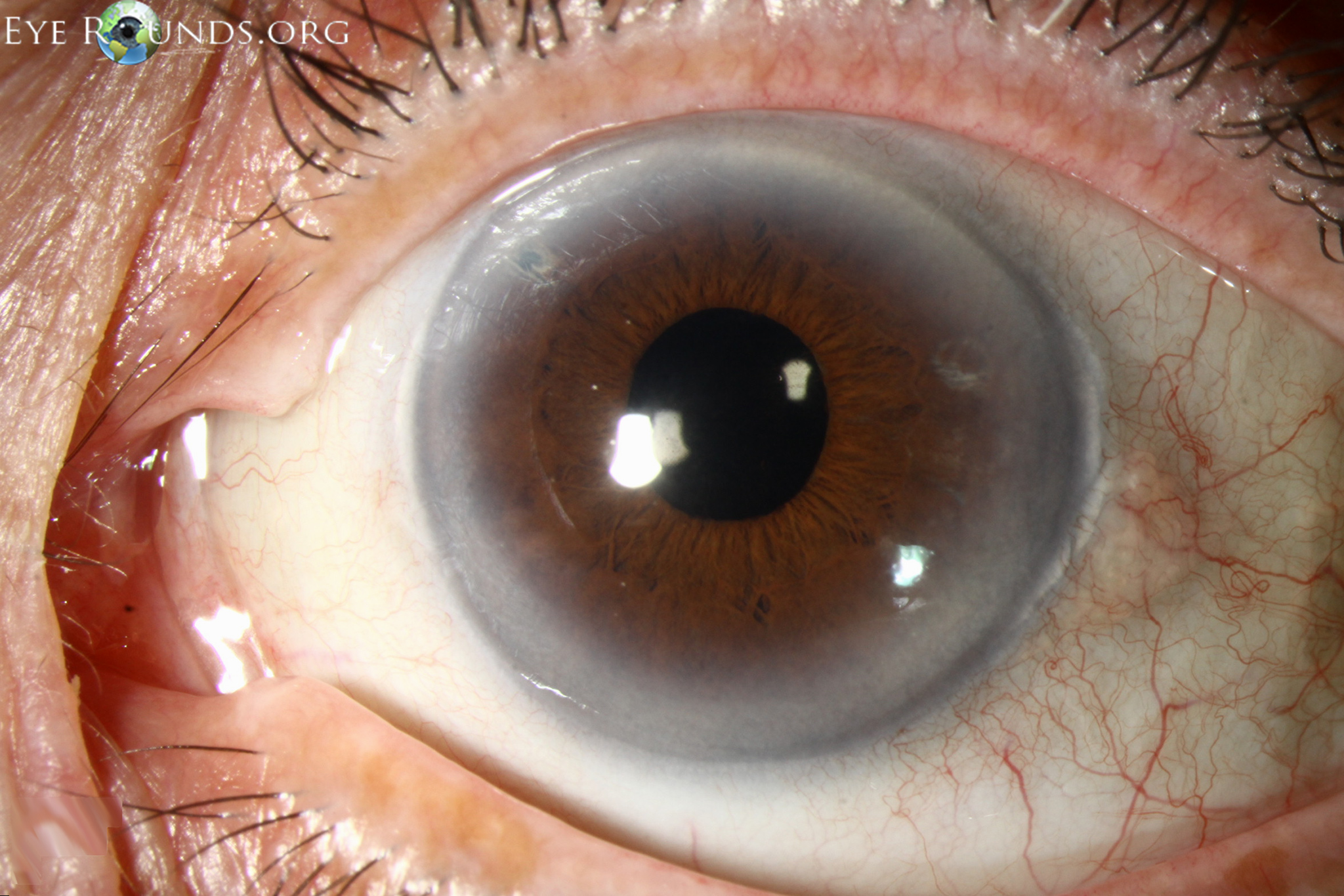 <p>gray/white arc circle around iris common with aging </p>