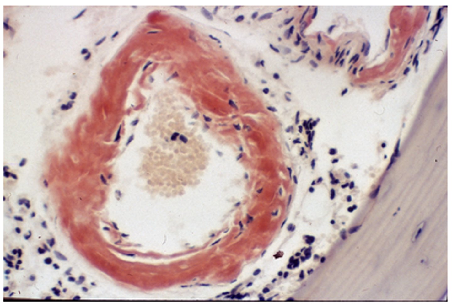 <p>Thioflavin T</p><p>Feedback:</p><p>Thioflavin T will also demonstrate amyloid, the substance stained red in this image. Mucicarmine stains acidic mucosubstances; Sudan black B stains lipids, and auramine-rhodamine stains acid-fast bacilli.</p>