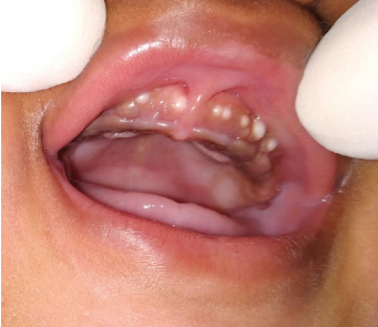 <p>The mother of a 1 month old baby has a concern of white nodules in the mouth of her kid. The clinical image is shown below. There is no pain or any other symptoms. Provide diagnosis and managent</p>