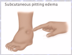 <p>excess fluid accumulates in particular location</p><p>EDEMA (abnormal accumulation of interstitial (in-between cells) fluid)</p>