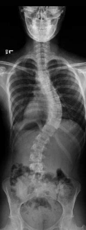 <p>Scoliosis</p>