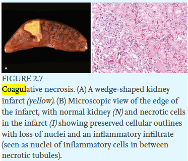 <p><span style="background-color: transparent; font-family: "Times New Roman", serif;"><strong>Gross Morphology: </strong>A <strong>wedge-shaped pale area</strong> (infarct) appears, with the apex pointing toward the site of vascular obstruction</span></p>