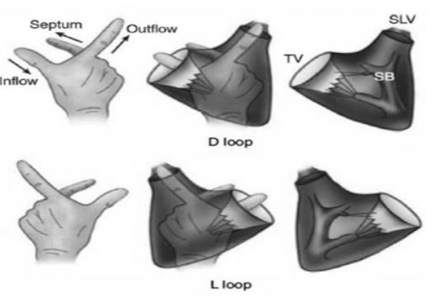 <p>Thumb is for the inflow </p><p>pointer is for the outflow </p><p>Right hand D-Loop</p><p>Left hand L -loop</p><p>The point of this rule is to determine the looping of the ventricle </p>