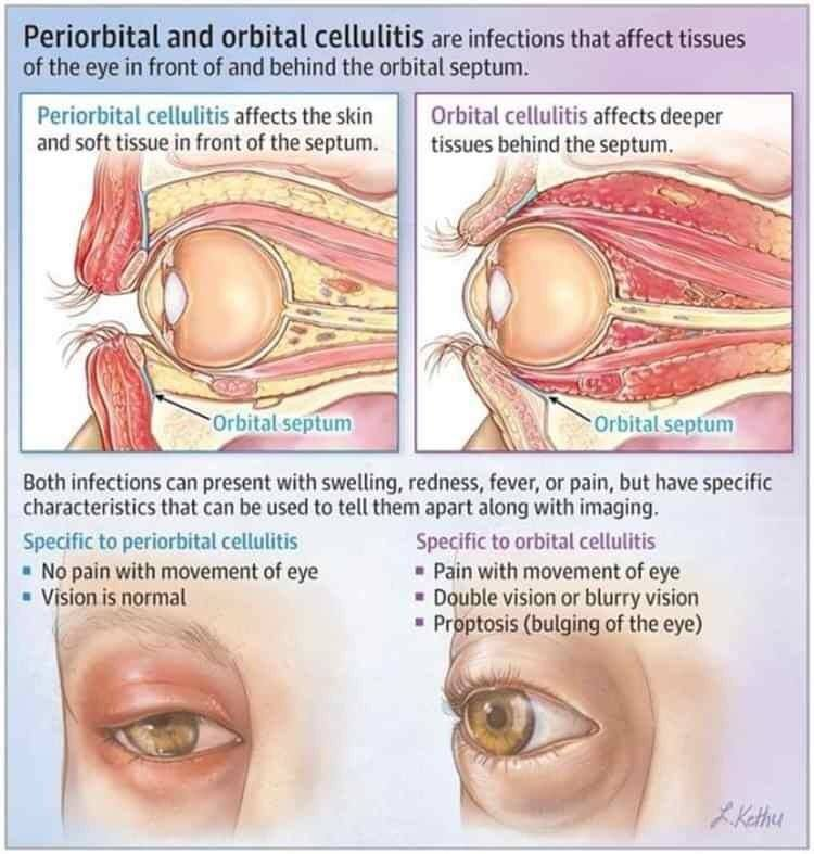 <p><u>preseptal</u><br>erythema limited to the eyelid</p><p>TX: PO abx</p><p><u>orbital</u><br>erythema surrounds whole eye<br>limited ocular movement<br>decreased vision<br>chemosis (swollen conjunctiva)<br>proptosis (eyes pop out)</p><p>TX: IV abx</p>