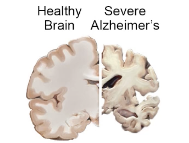 <p>death of neurons in brain→shrinkage of brain tissue</p>