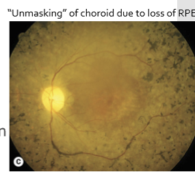 <ul><li><p>Most common hereditary fundus disorder</p></li><li><p>Can be autosomal dominant, autosomal recessive, or X-linked</p></li><li><p>Symptoms typically begin in the 1st to 3rd decades of life</p></li></ul><p></p>