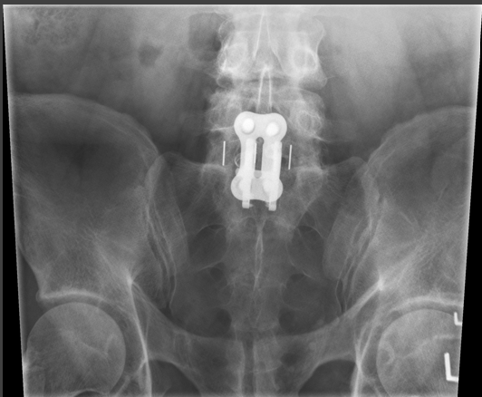 <p>critique for SI joint AP axial </p>