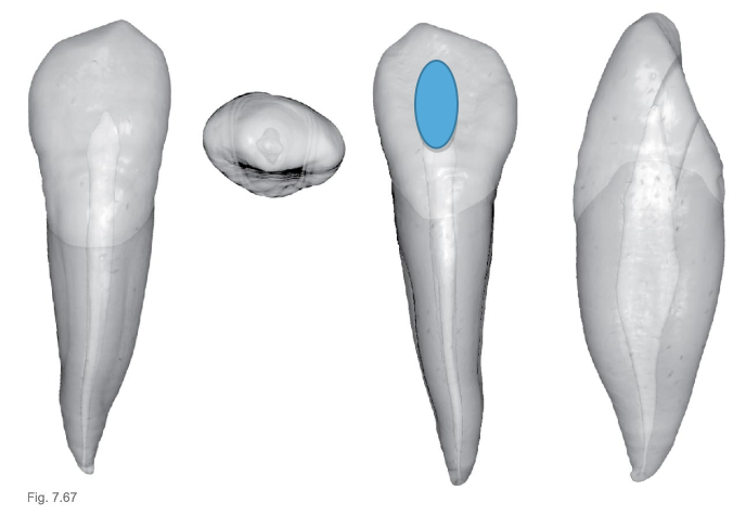 <p>What % of mandibular canines have 2 canals?</p>