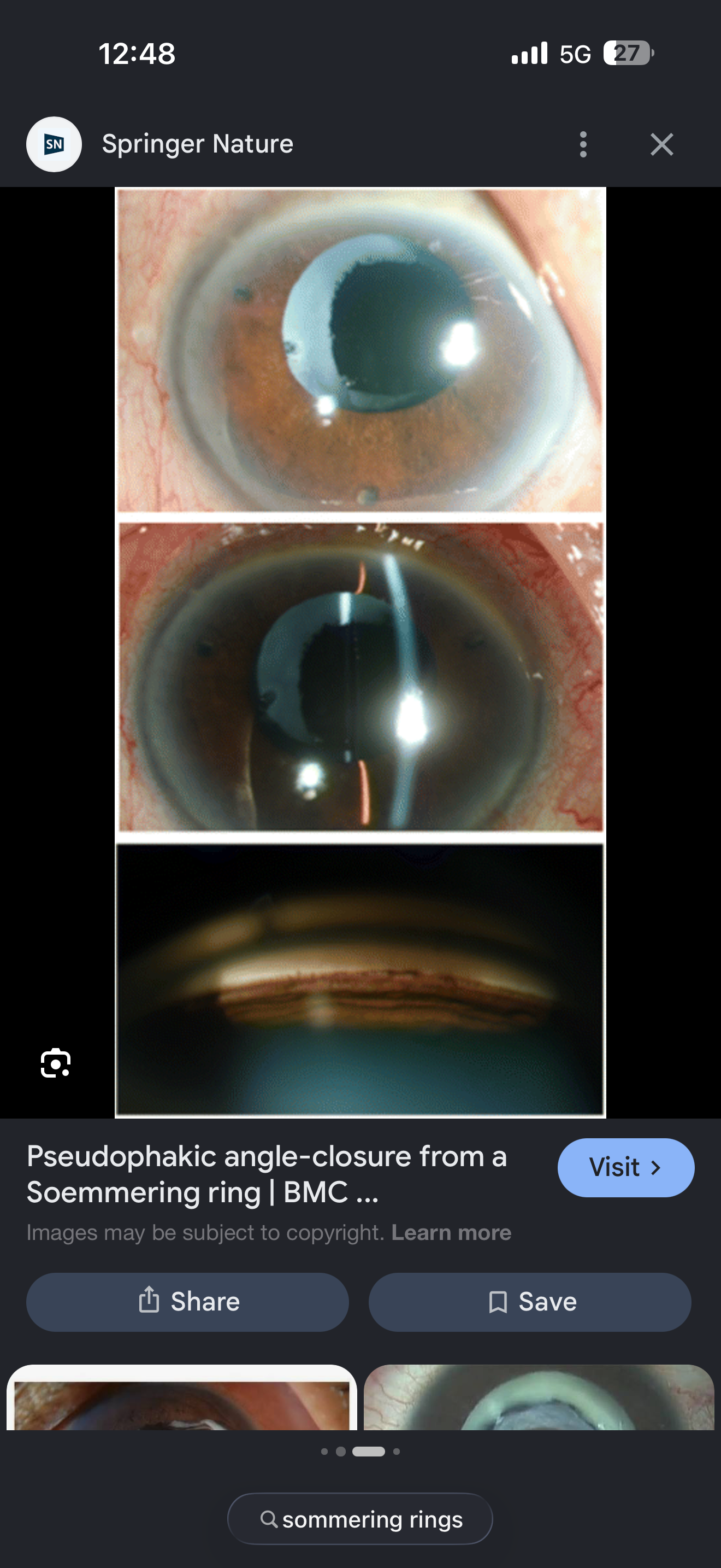 <p>Late complicn of cararact sx</p>