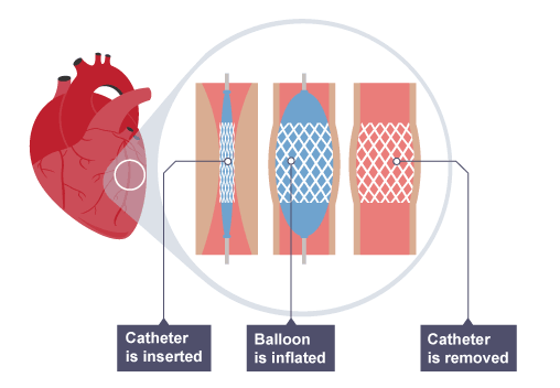 <p>Metal tubes — keeps arteries open → blood can flow</p>