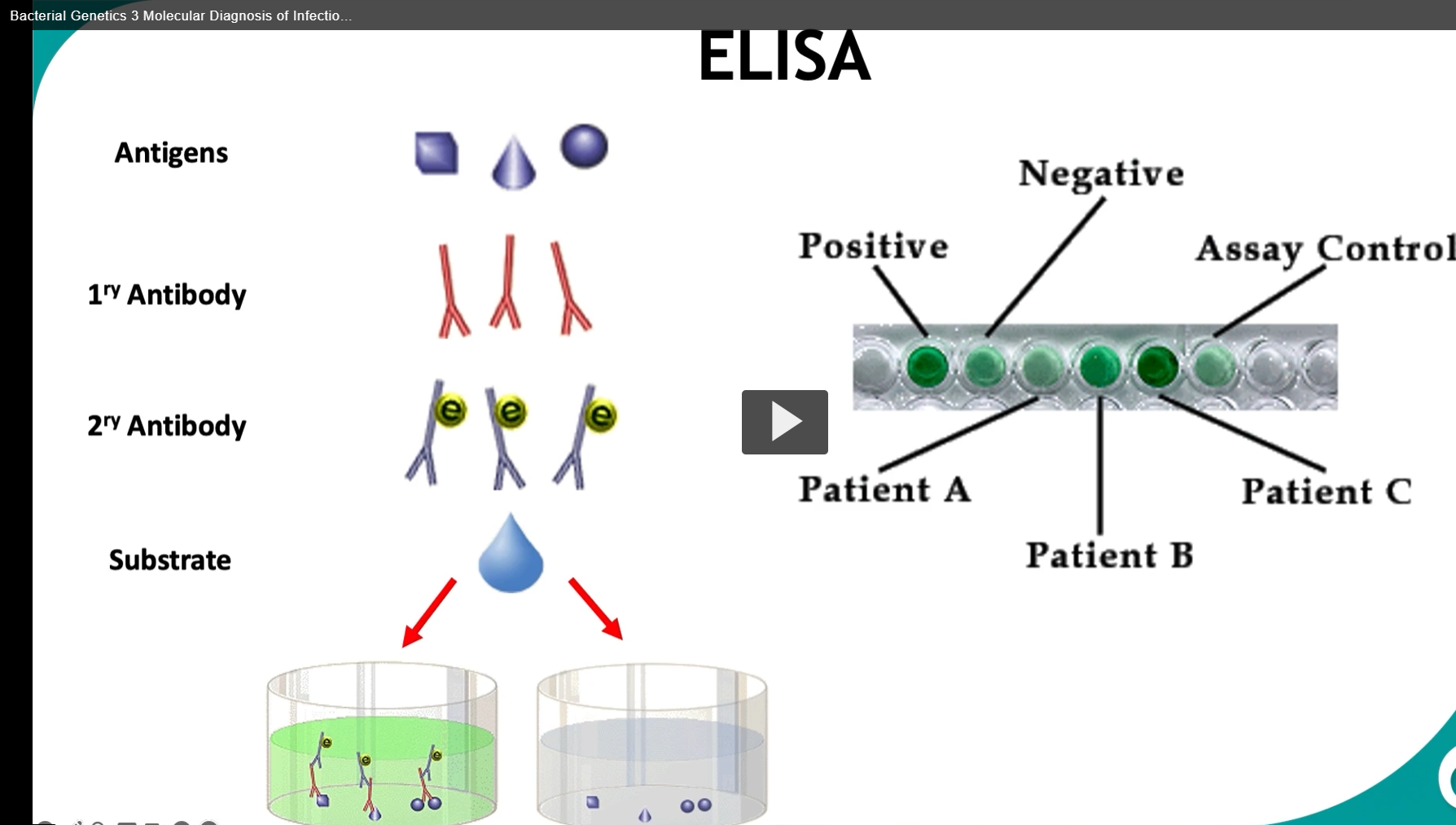 <p>ELISA — Definition &amp; Etymology</p><p><strong>Definition:</strong><br><strong>ELISA</strong> stands for <strong>Enzyme-Linked Immunosorbent Assay</strong>.<br>It is a laboratory technique used to <strong>detect and quantify specific antigens or antibodies</strong> in a sample (e.g., blood, serum). It works by using <strong>antibody–antigen specificity</strong> and an <strong>enzyme-driven color change</strong> as a readout.</p><p>Etymology (break it down)</p><ul><li><p><strong>Enzyme</strong></p><ul><li><p><em>en-</em> = “in”</p></li><li><p><em>zyme</em> (Greek <em>zymē</em>) = “ferment, yeast”<br>→ A molecule that <strong>drives biochemical reactions</strong></p></li></ul></li><li><p><strong>Linked</strong><br>→ The enzyme is <strong>attached (linked)</strong> to an antibody</p></li><li><p><strong>Immuno-</strong></p><ul><li><p>Latin <em>immunis</em> = “exempt, protected”<br>→ Refers to the <strong>immune system</strong></p></li></ul></li><li><p><strong>Sorbent</strong></p><ul><li><p>Latin <em>sorbere</em> = “to absorb or suck in”<br>→ The assay uses a surface that <strong>binds (absorbs) molecules</strong></p></li></ul></li><li><p><strong>Assay</strong></p><ul><li><p>Old French <em>assai</em> = “trial, test”<br>→ A <strong>test or analytical procedure</strong></p></li></ul></li></ul><p>Put together: <strong>“A test where immune molecules are captured on a surface and detected using an enzyme-linked signal.”</strong></p><p>What’s happening in the diagram (step-by-step)</p><p>This slide shows a <strong>typical indirect ELISA</strong> workflow:</p><p></p><div data-type="horizontalRule"><hr></div><p>1. <strong>Antigen is present (top row)</strong></p><ul><li><p>Different shapes = different <strong>antigens</strong> (targets you’re trying to detect)</p></li></ul><p>2. <strong>Primary antibody (1° antibody) binds antigen</strong></p><ul><li><p>The <strong>primary antibody</strong> is <strong>specific </strong>to the <strong>antigen</strong></p></li><li><p>If the antigen is present → antibody binds</p></li><li><p>If not → nothing binds</p></li></ul><p>3. <strong>Secondary antibody (2° antibody) binds the primary</strong></p><ul><li><p>The <strong>secondary antibody</strong> recognizes the primary antibody</p></li><li><p>It is <strong>enzyme-linked</strong> (the yellow “e” in the diagram)</p></li><li><p>This step <strong>amplifies the signal</strong> (more enzymes per antigen)</p></li></ul><p>4. <strong>Substrate is added</strong></p><ul><li><p>A <strong>substrate</strong> (colorless chemical) is added</p></li><li><p>The enzyme converts it into a <strong>colored product</strong></p></li></ul><p>5. <strong>Color change = positive result</strong></p><ul><li><p><strong>Green color → Positive</strong><br>→ Antigen was present → full antibody chain formed → enzyme reaction occurred</p></li><li><p><strong>Clear/no color → Negative</strong><br>→ No antigen → no enzyme → no reaction</p></li></ul><p></p><div data-type="horizontalRule"><hr></div><p><span data-name="test_tube" data-type="emoji">🧪</span> Interpreting the plate (right side)</p><ul><li><p><strong>Patient A</strong> → dark green → <strong>strong positive</strong></p></li><li><p><strong>Patient B</strong> → lighter green → <strong>weaker positive (lower concentration)</strong></p></li><li><p><strong>Patient C</strong> → no color → <strong>negative</strong></p></li><li><p><strong>Assay control</strong> → ensures the test is working properly</p></li></ul><p></p><div data-type="horizontalRule"><hr></div><p>Conceptual takeaway (important for exams)</p><p>ELISA is essentially: <strong>“Convert invisible molecular binding into a visible color signal.”</strong></p><ul><li><p><strong>Specificity</strong> → antibody–antigen binding</p></li><li><p><strong>Sensitivity</strong> → enzyme amplification</p></li><li><p><strong>Readout</strong> → color intensity ∝ amount of target</p></li></ul><p></p>