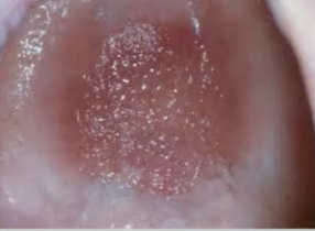 <p>benign reactive lesion often caused by illfitting dentures, CANDIDA</p>