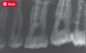 <p>Dark Radiograph </p><p><strong>What it looks like:</strong><br>Image is <strong>too dark</strong>.</p><p> </p><p><strong>Cause:</strong><br>Overexposure or overdevelopment.</p>