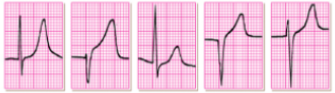 <p>what does this EKG show? </p>