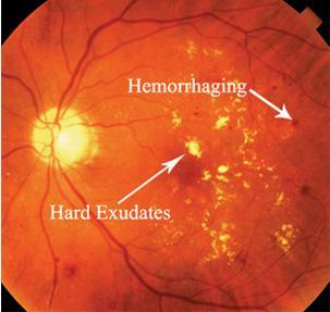 <p>nonproliferative diabetic retinopathy (NDPR) sx*</p>