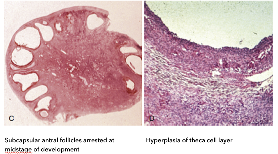 <ul><li><p><strong>C: Follicle characteristics:</strong></p><ul><li><p><strong>Subcapsular antral follicles</strong> (located just under capsule, near cortex)</p></li><li><p><strong>Arrested at mid-stage development</strong> (do not fully mature)</p></li><li><p>Appear as <strong>“string of pearls”</strong> pattern</p></li></ul></li><li><p><strong>D: Cellular changes:</strong></p><ul><li><p><strong>Hyperplasia of theca cell layer</strong></p></li><li><p>↑ rate of cell reproduction → <strong>↑ androgen (steroid) production</strong></p></li></ul></li><li><p><strong>Key idea:</strong></p><ul><li><p>Arrested follicles + ↑ androgen-producing cells → core pathology of PCOS</p></li></ul></li></ul><p></p>