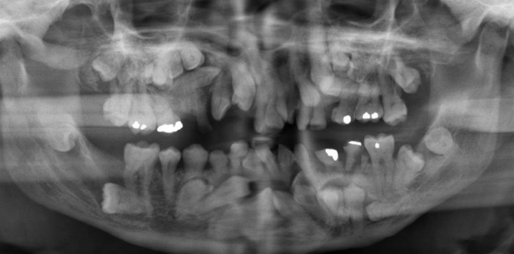 <p>found in gardner syndrome (20%) and cleidocranial dysplasia  (more common)</p>