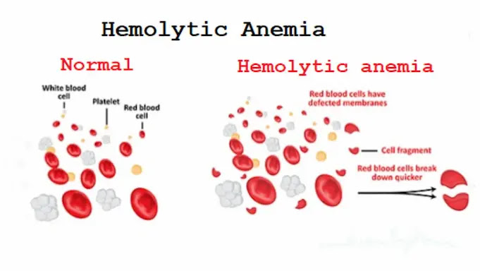 <p>Inherited, defects in cell membranes cause rupture</p><p>-include sickle cell and thalassemia</p>
