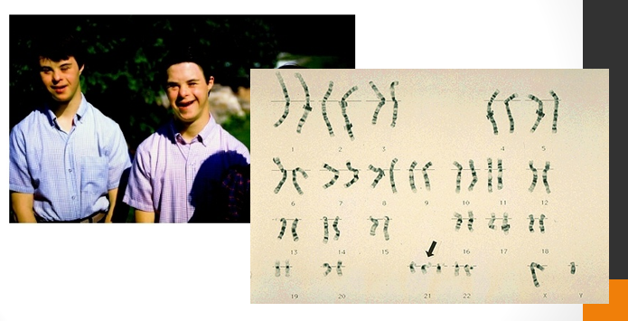 <p><strong>trisomy 21</strong></p><p>most commonly known</p><p>common facial features</p><p>short stature & short fingers and toes</p><p>large tongue - speech difficult</p><p>mental disability</p>