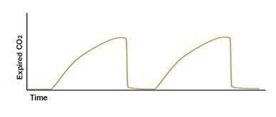 <p>The following capnography tracing is observed following intubation:</p><p>This waveform is consistent with   </p><p>A. cardiac arrest.  </p><p>B. normal exhalation.  </p><p>C. air leak.  </p><p>D. airflow obstruction. </p>