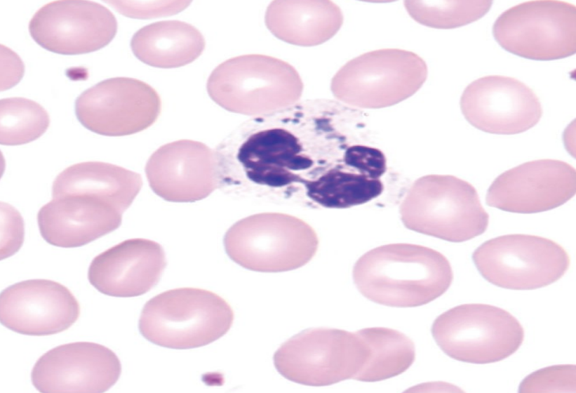 <p>what are the characteristics of chediak-higashi syndrome?</p>