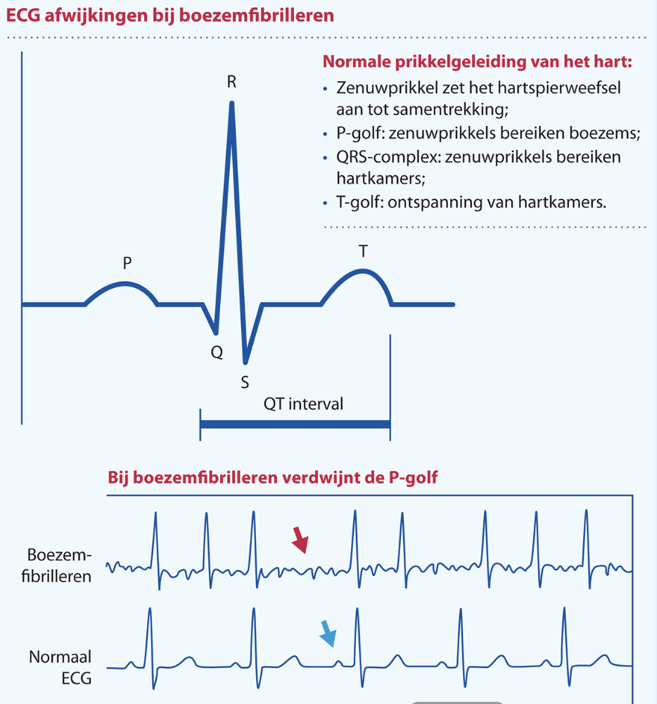 <p>hartritmestoornis, waarbij atria snel en chaotisch samentrekken → geeft onregelmatig en vaak versnelde hartslag</p><ul><li><p>pompwerking van hart minder effectief + risico op complicaties (bv beroerte)</p></li></ul><p></p>