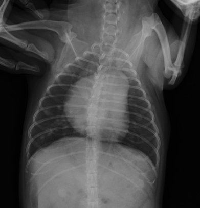 <p>Patent ductus arteriosus</p>