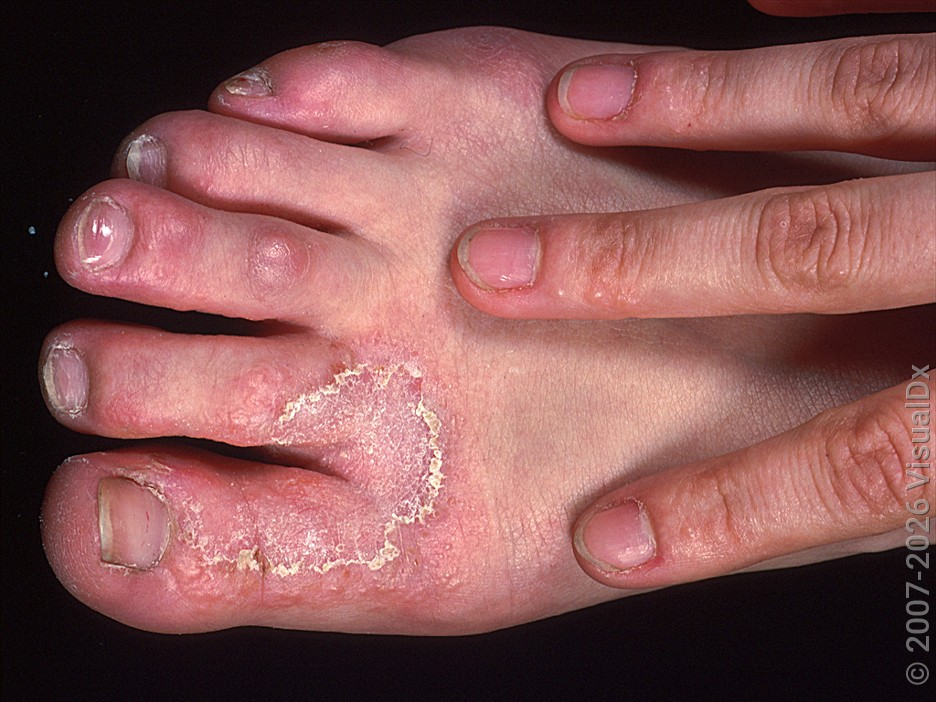 <p>Tinea pedis</p>