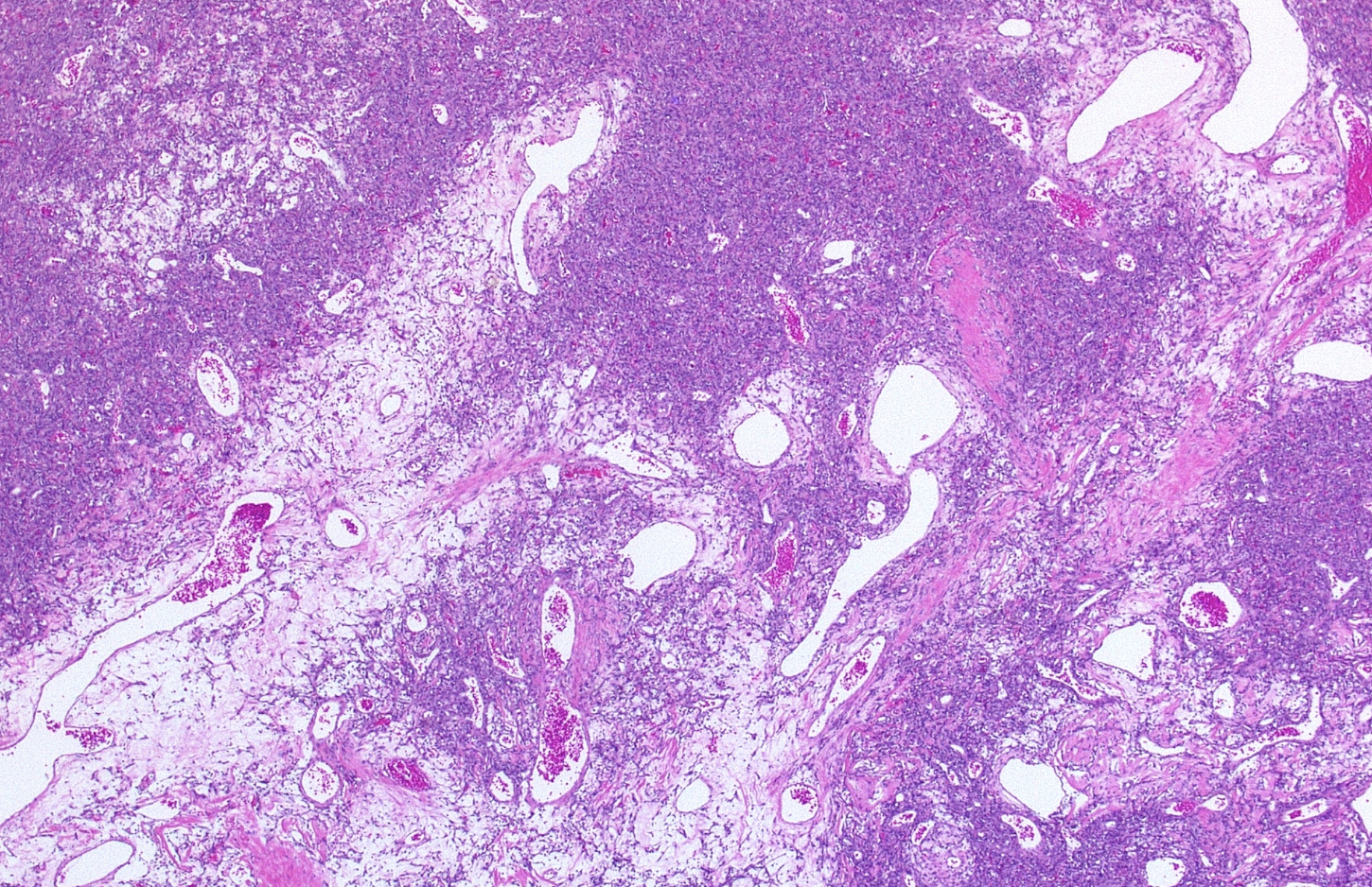<p>Tumeur plèvre patient de 45 ans </p><p>Diagnostic</p><p>age</p><p>localisation </p><p>clinique particulipre</p><p>Histologie</p><p>IHC</p><p>Moléculaire </p>