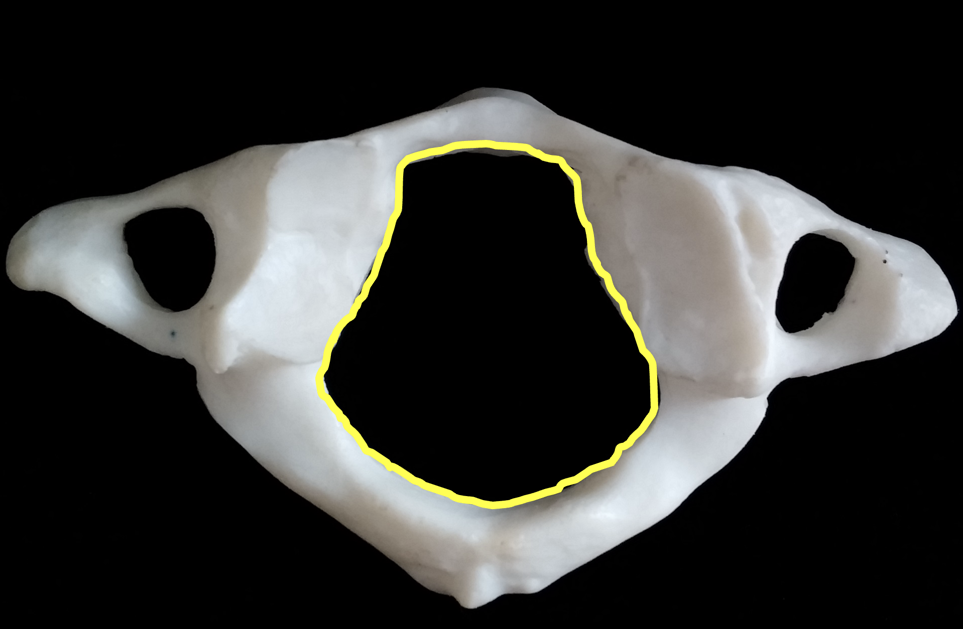 <p>What is the yellow region highlighted on C1, atlas?</p>