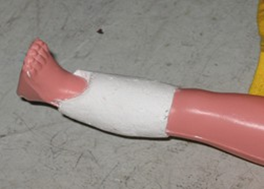 <p><span>fracture of the distal third of tibia and fibula with callus formation</span></p>