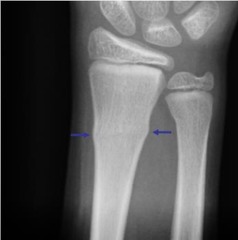 <p>affected bone compresses causing a bulge in the cortex w/o a break (common in peds)</p>