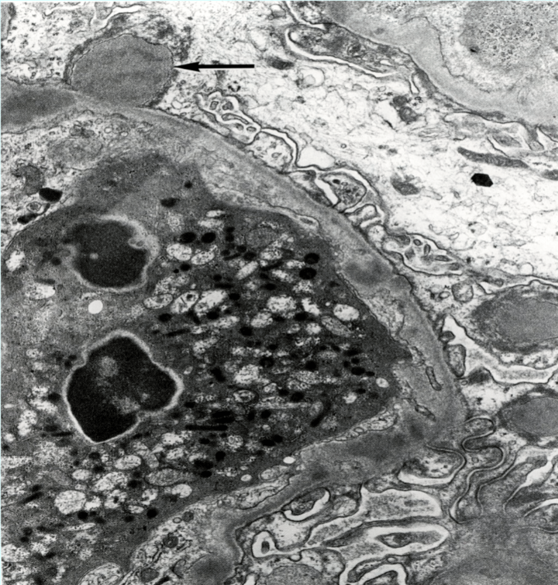 <p>Acute Post-Streptococcal Glomerulonephritis</p>