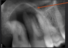 <p>What is the abnormality of the arrow?</p>