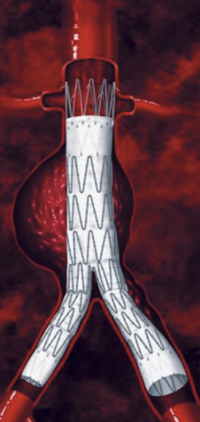 <p>Form of TX for abdominal aortic aneurysm (AAA) reinforcing the wall to prevent rupture</p>