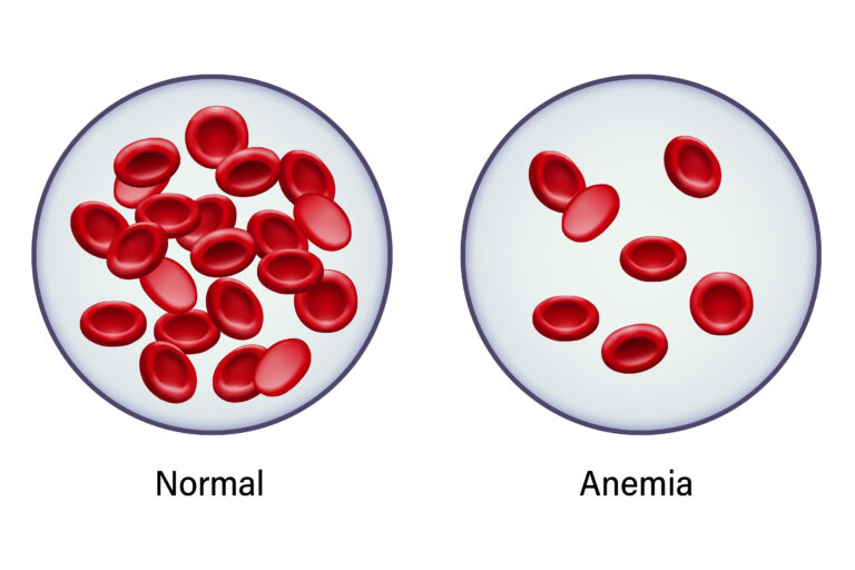 <p>insufficient amount of healthy red blood cells or hemoglobin to carry oxygen to the body’s tissues</p><ul><li><p>caused by low iron, blood, or nutrient</p></li><li><p>symptoms: fatigue, dizziness, pale skin</p></li></ul><p></p>