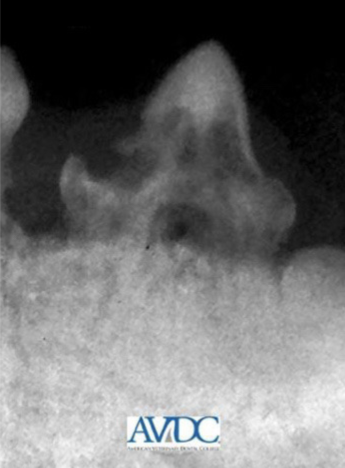 <p>Which tooth resorption stage? What is happening and what should you do?</p>