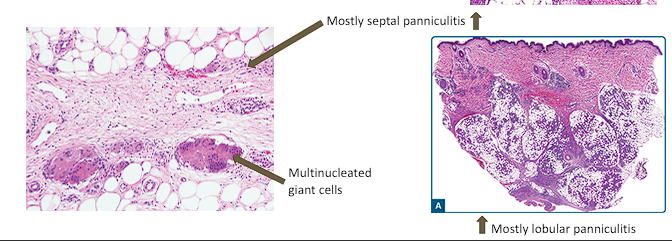 <ul><li><p>Inflammation of the <span style="color: red;"><strong>subcutaneous fat</strong></span></p></li><li><p><strong>Septal thickening/fibrosis</strong> in some cases of septal inflammation</p></li><li><p><span style="color: red;"><strong>Foamy histiocytes</strong></span><strong> </strong>and <span style="color: red;"><strong>multinucleated giant cells</strong> </span>due to necrosis within fat</p></li></ul><p></p>