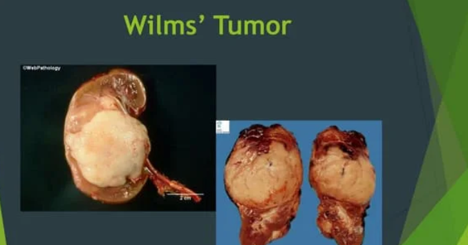 <ul><li><p>most common <span style="color: rgb(146, 22, 22);"><strong>kidney cancer </strong></span><span style="color: rgb(22, 18, 18);">in children</span><span style="color: rgb(146, 22, 22);"> <strong>(2-3 y/o</strong>)</span></p></li></ul><p></p>