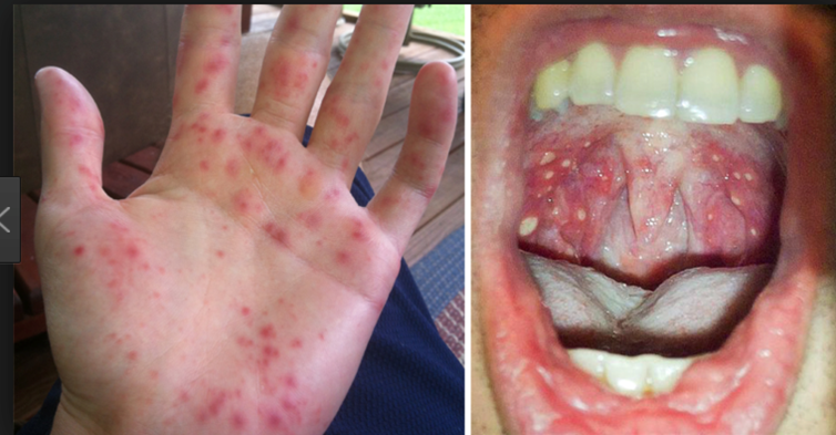 <p>Causative Agent: Enterovirus of the Picornaviridae family, Majority from Coxsackievirus A16 and Enterovirus 71<br>Symptoms/Signs: Usually affects children; Fever, Painful rush originating in the back of the mouth, palms of hands, and soles of feet.</p>