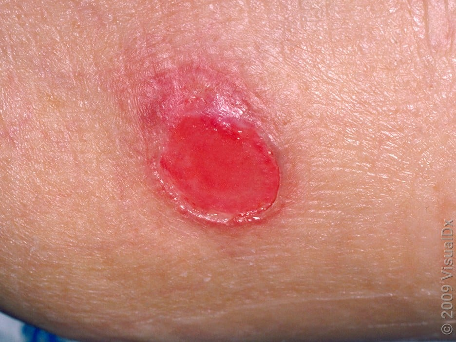 <p>What pressure sore does this depict?</p>