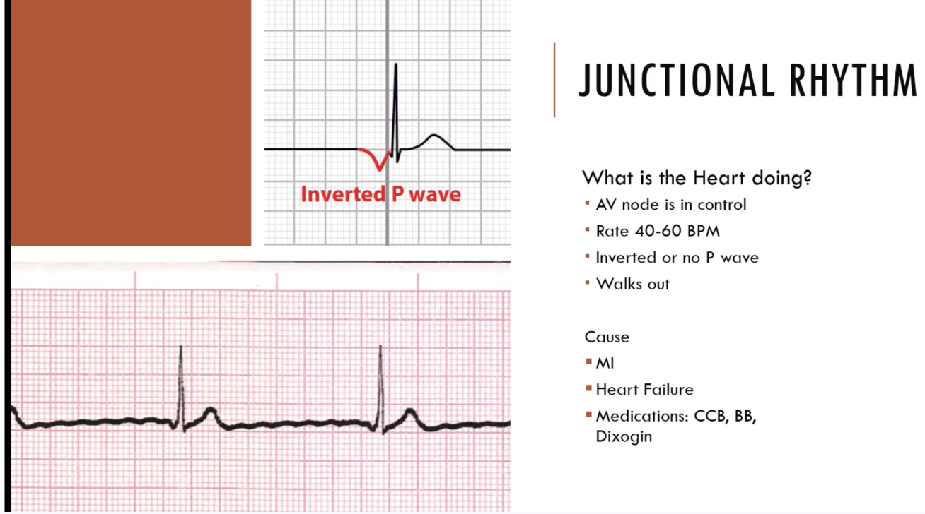 <p>junctional rhythm</p>